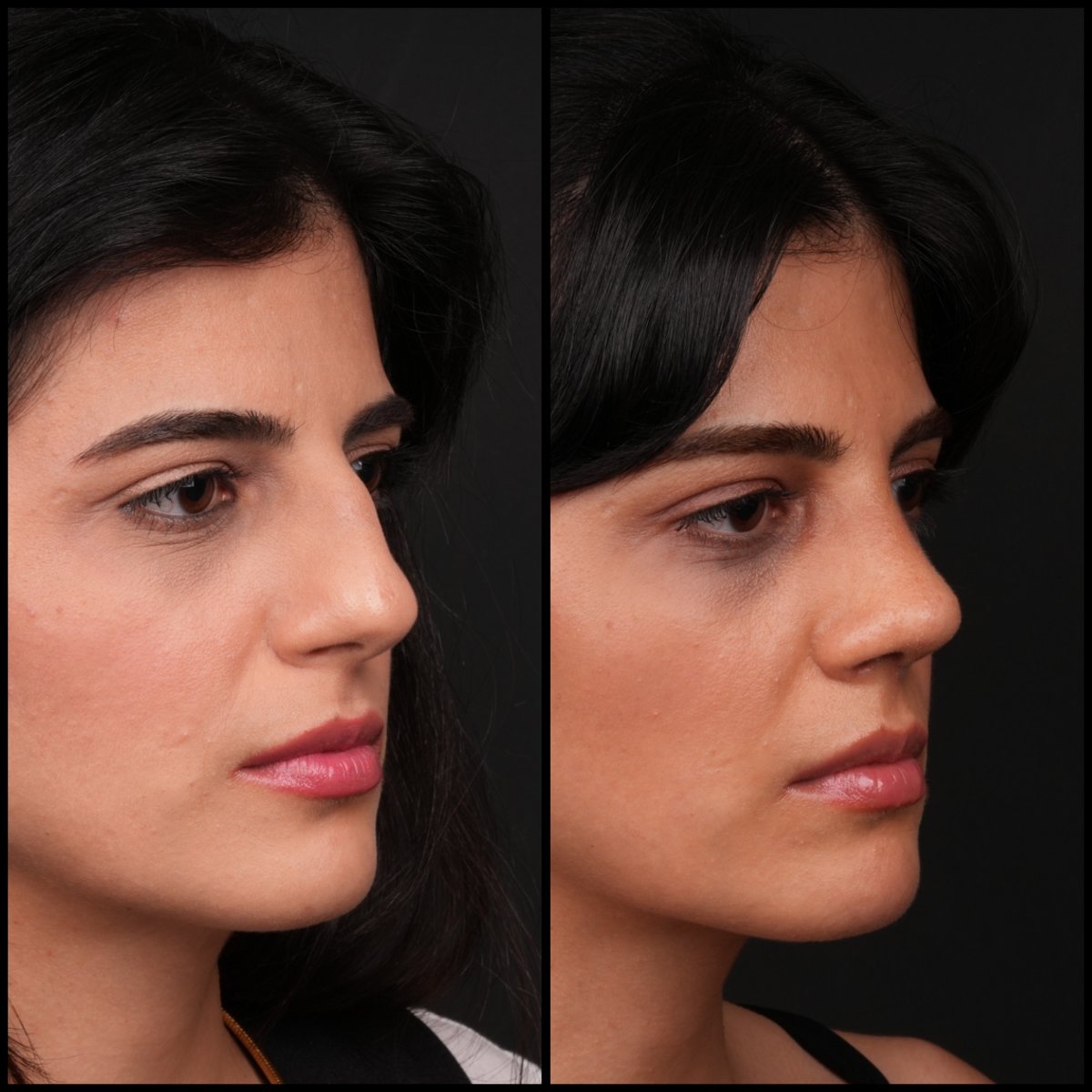 Before and after rhinoplasty results at Medipol Acibadem District Hospital, nose reshaping