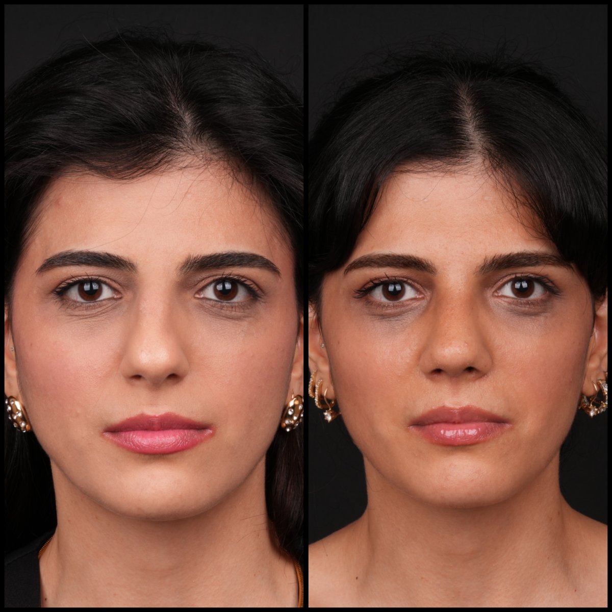Vorher-nachher-Ergebnis der Nasenkorrektur in Medipol Acibadem District Hospital, Rhinoplastik