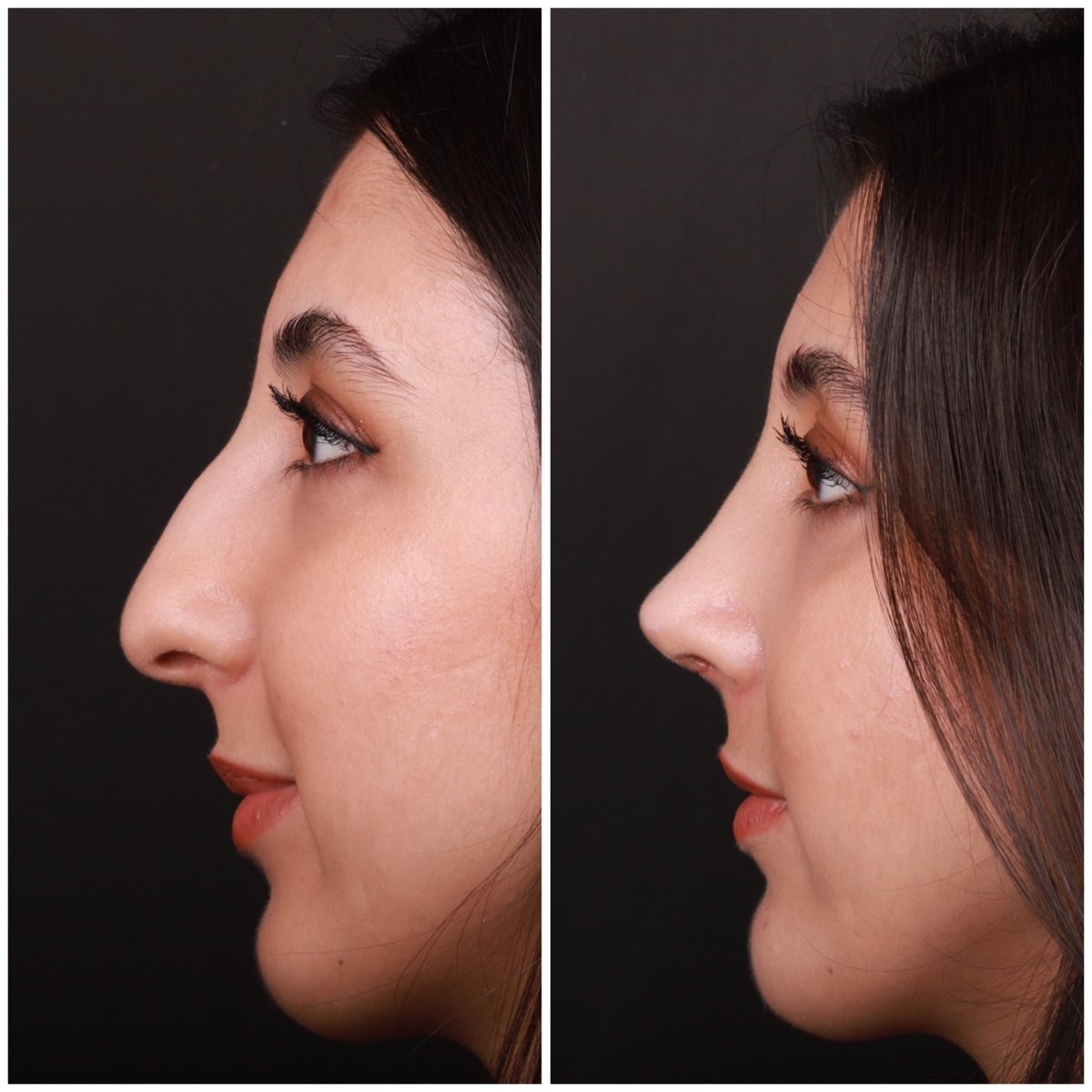 Efekty przed i po rhinoplastyce w Medipol Acibadem District Hospital, korekta nosa