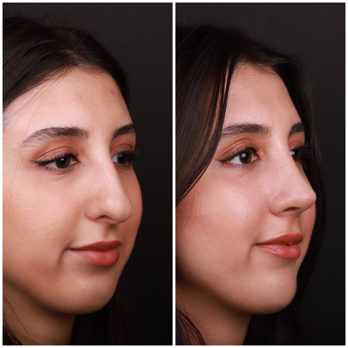 Resultados de rinoplastia antes y después en Medipol Acibadem District Hospital, remodelación nasal