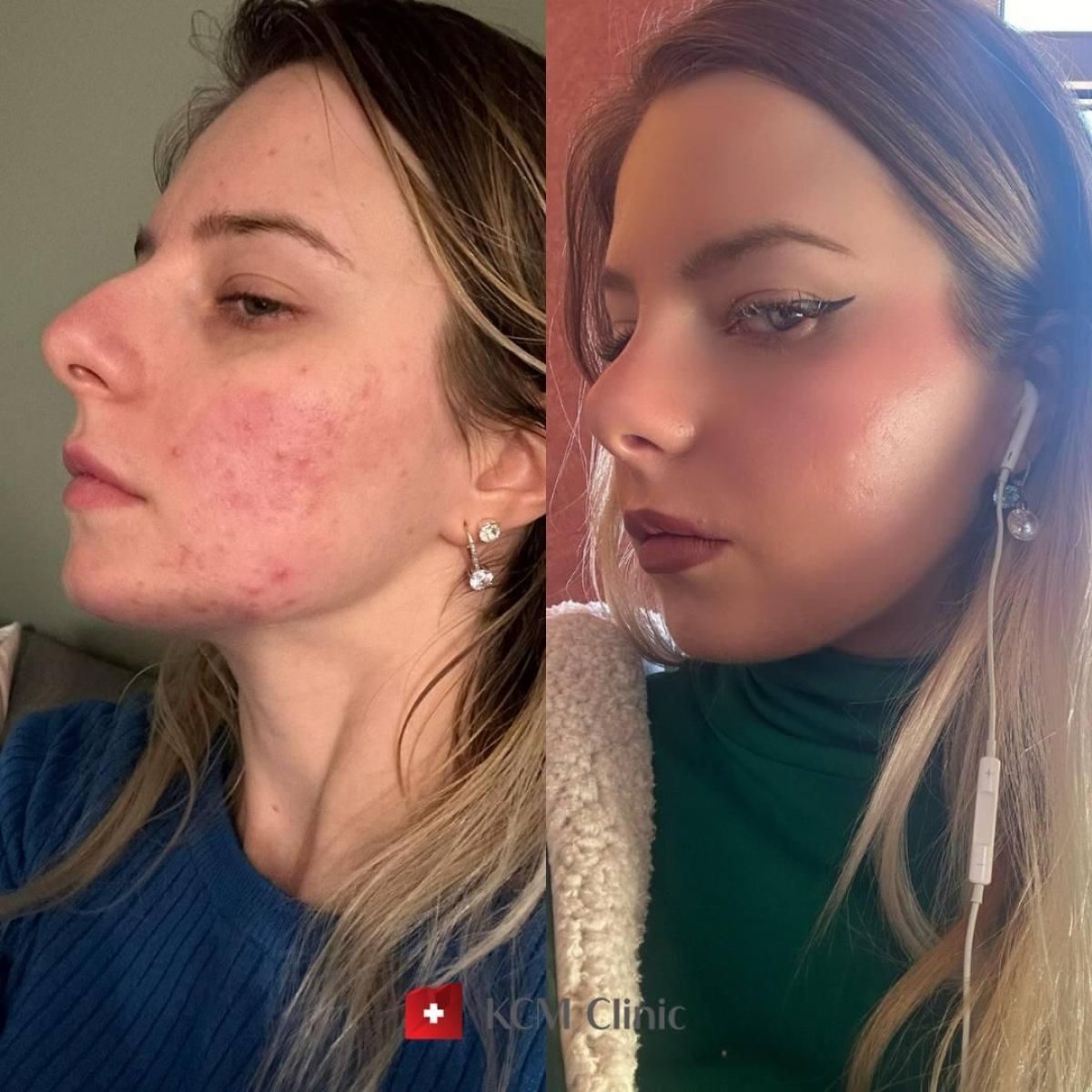 Before and after acne treatment results at KCM Clinic – clearer, smoother facial skin