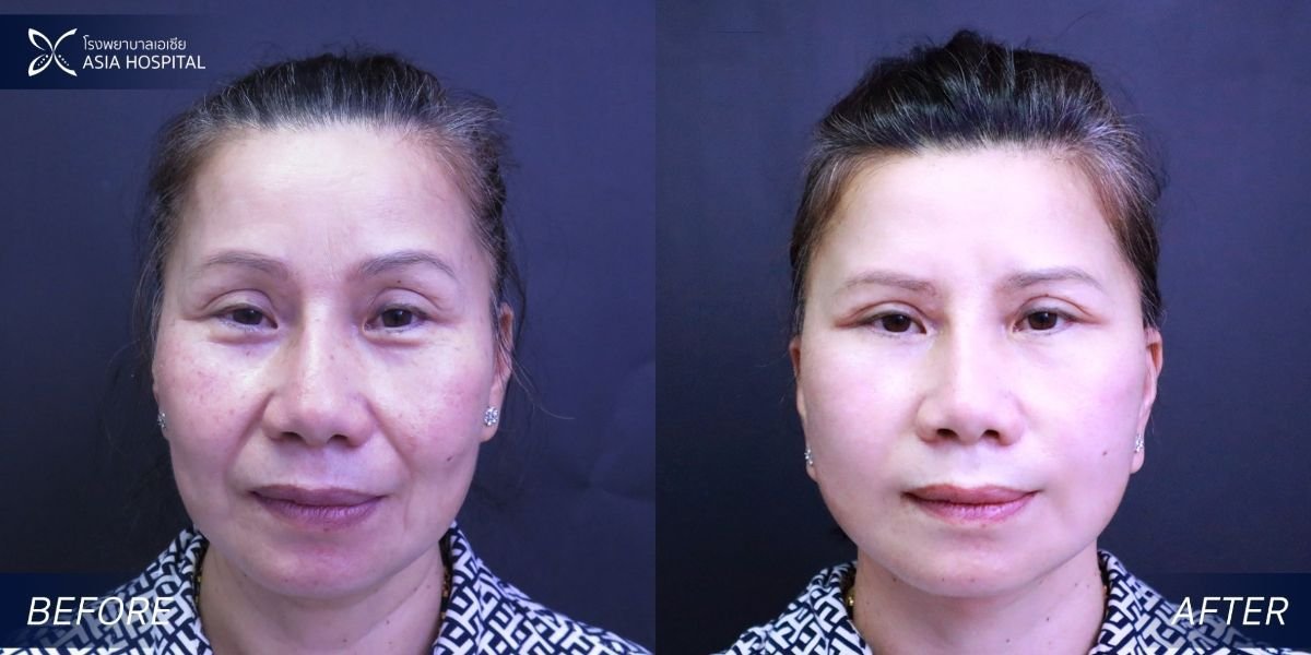 Before and after mini facelift results at Asia Cosmetic Hospital, facial rejuvenation procedure