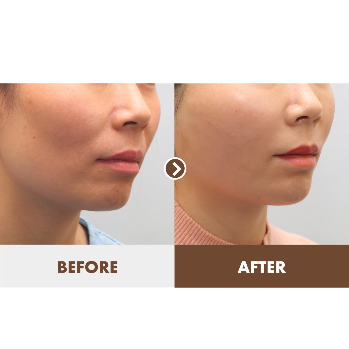 Résultats lifting visage avant/après chez Dr. Tak Plastic Surgery, contour du visage amélioré