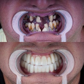Special Price for Full Mouth Smile Makeover - Metal Supported Porcelain Crown - Hollywood Smile - 12-12 Top&Bottom - photo 2