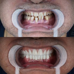 Special Price for Full Mouth Smile Makeover - Metal Supported Porcelain Crown - Hollywood Smile - 12-12 Top&Bottom - photo 3