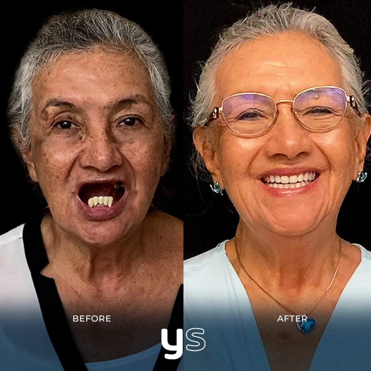 Résultats avant et après implants dentaires chez YeahSmile – sourire restauré