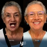 Before and after All-on-4 Dental Implants photos by Dr. Miller Vieira Paula