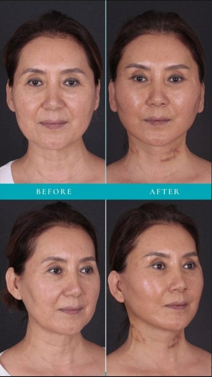 Before and after deep plane facelift results at Quartz Hospital – visible facial rejuvenation