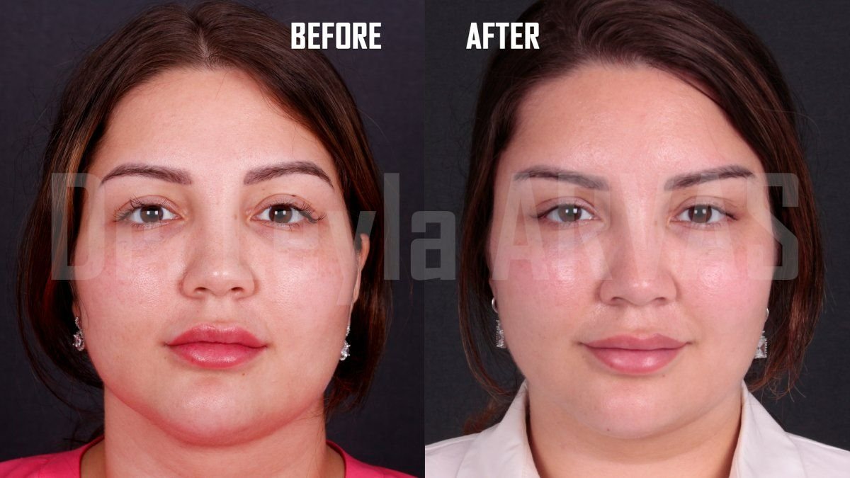 Deep plane facelift before and after results at Quartz Hospital, visible facial rejuvenation