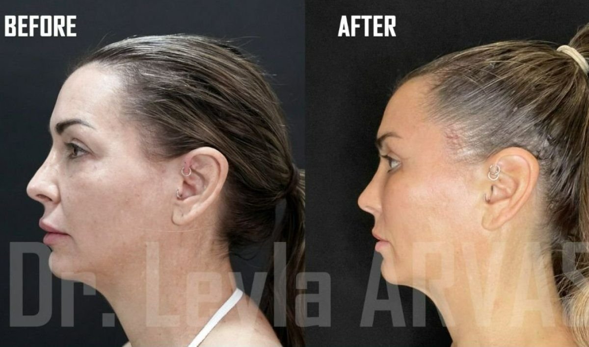 Before and after deep plane facelift results at Quartz Hospital, visible facial rejuvenation