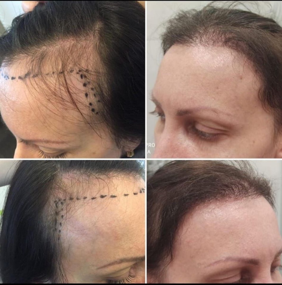 Resultados de trasplante capilar antes y después en Madame Safiye Clinic, línea restaurada