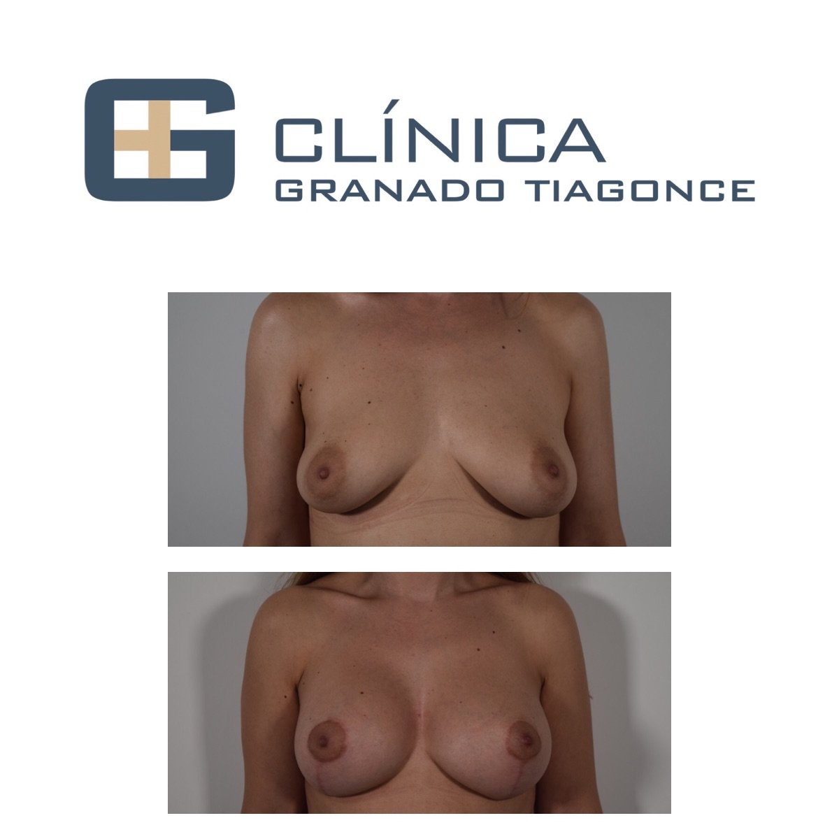 Avant-après implants mammaires avec lifting à Clinica Granado Tiagonce, forme améliorée