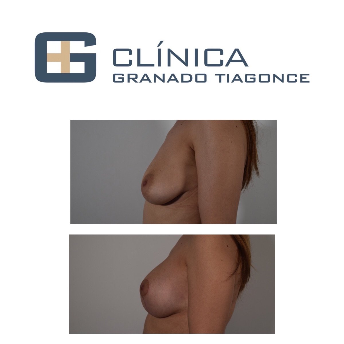 قبل وبعد تكبير ورفع الثدي في Clinica Granado Tiagonce، تحسين شكل الثدي