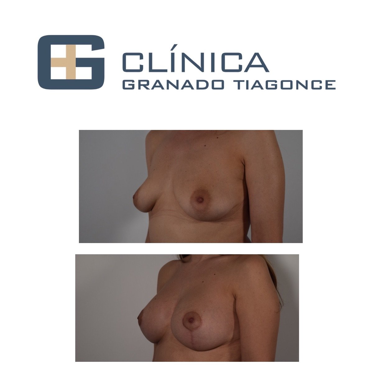 نتائج قبل وبعد تكبير ورفع الثدي في Clinica Granado Tiagonce، شكل محسّن