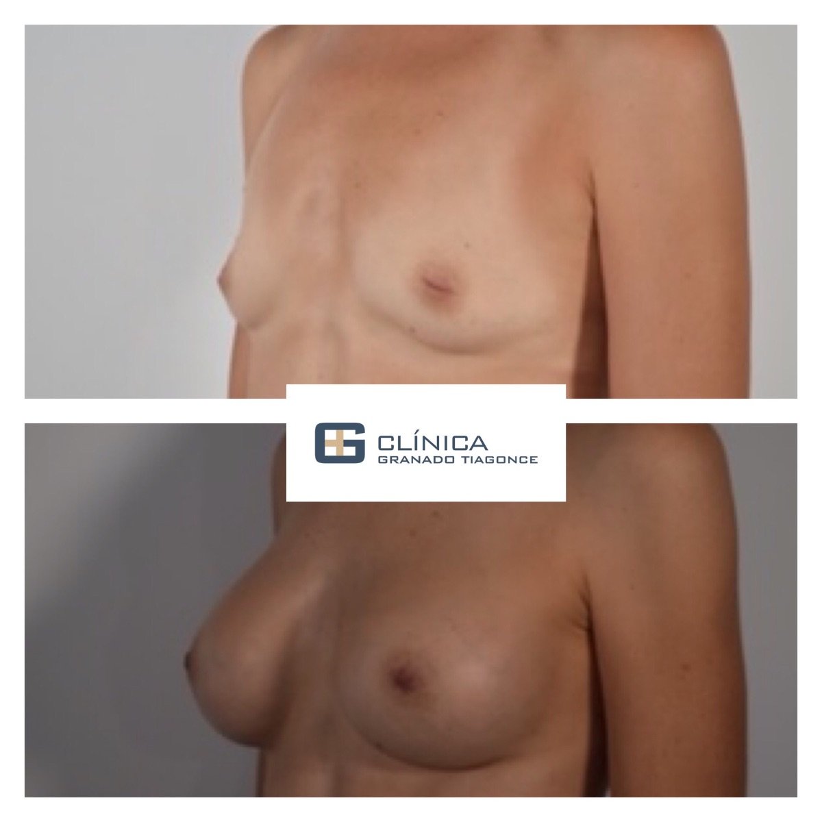 قبل وبعد تكبير ورفع الثدي في Clinica Granado Tiagonce، تحسين شكل الثدي