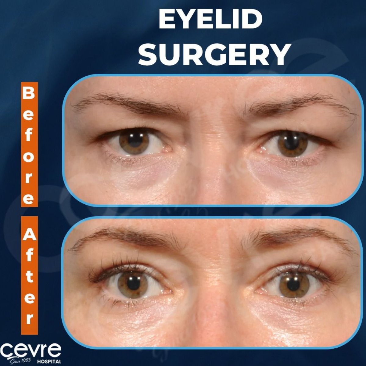 Before and after blepharoplasty results at Adem and Havva Medical Center, eyelid correction