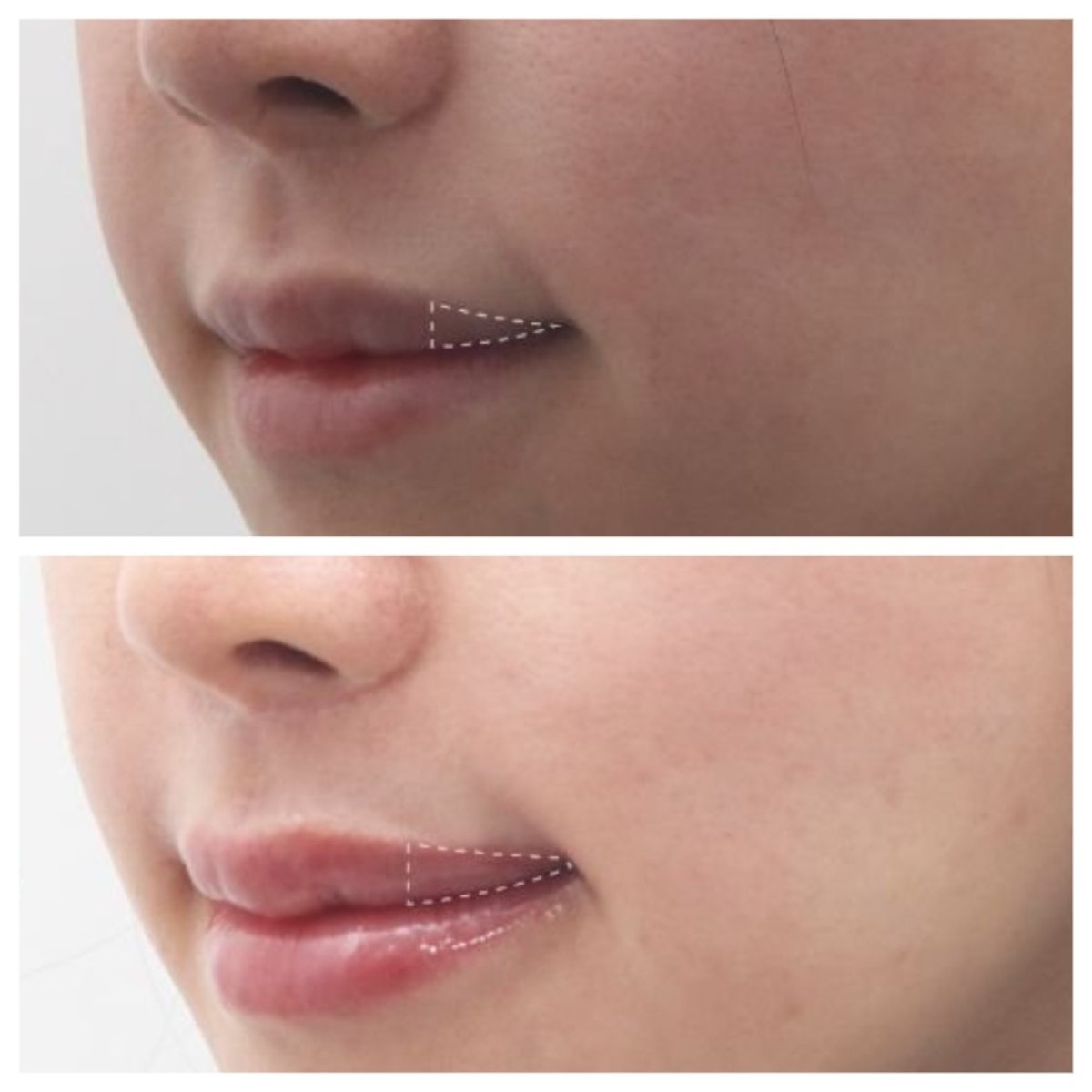 Before and after lip lift results at Dr. Tak Plastic Surgery, enhanced lip contour visible