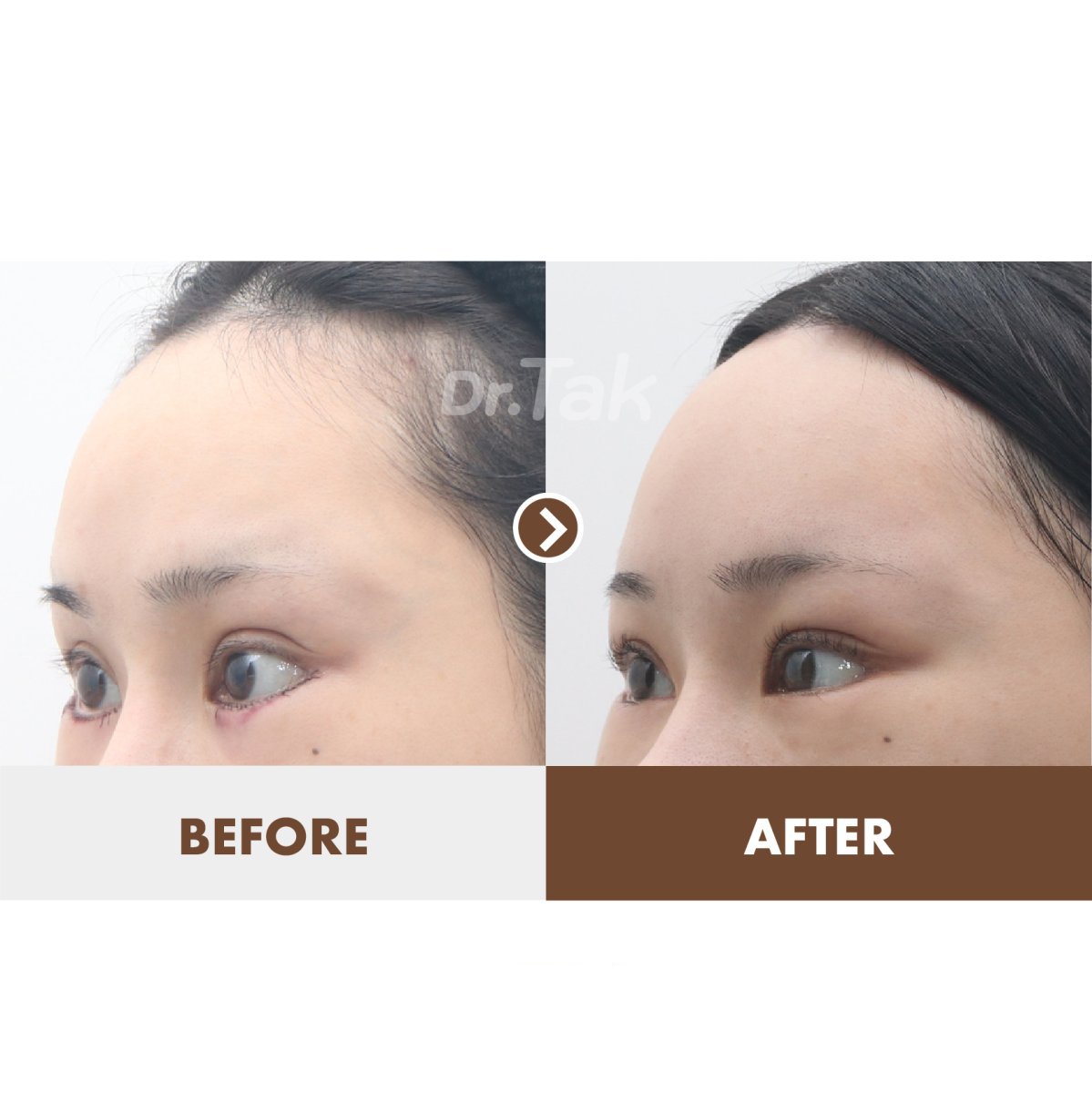 Результаты подтяжки лба до и после в Dr. Tak Plastic Surgery, гладкий контур лба