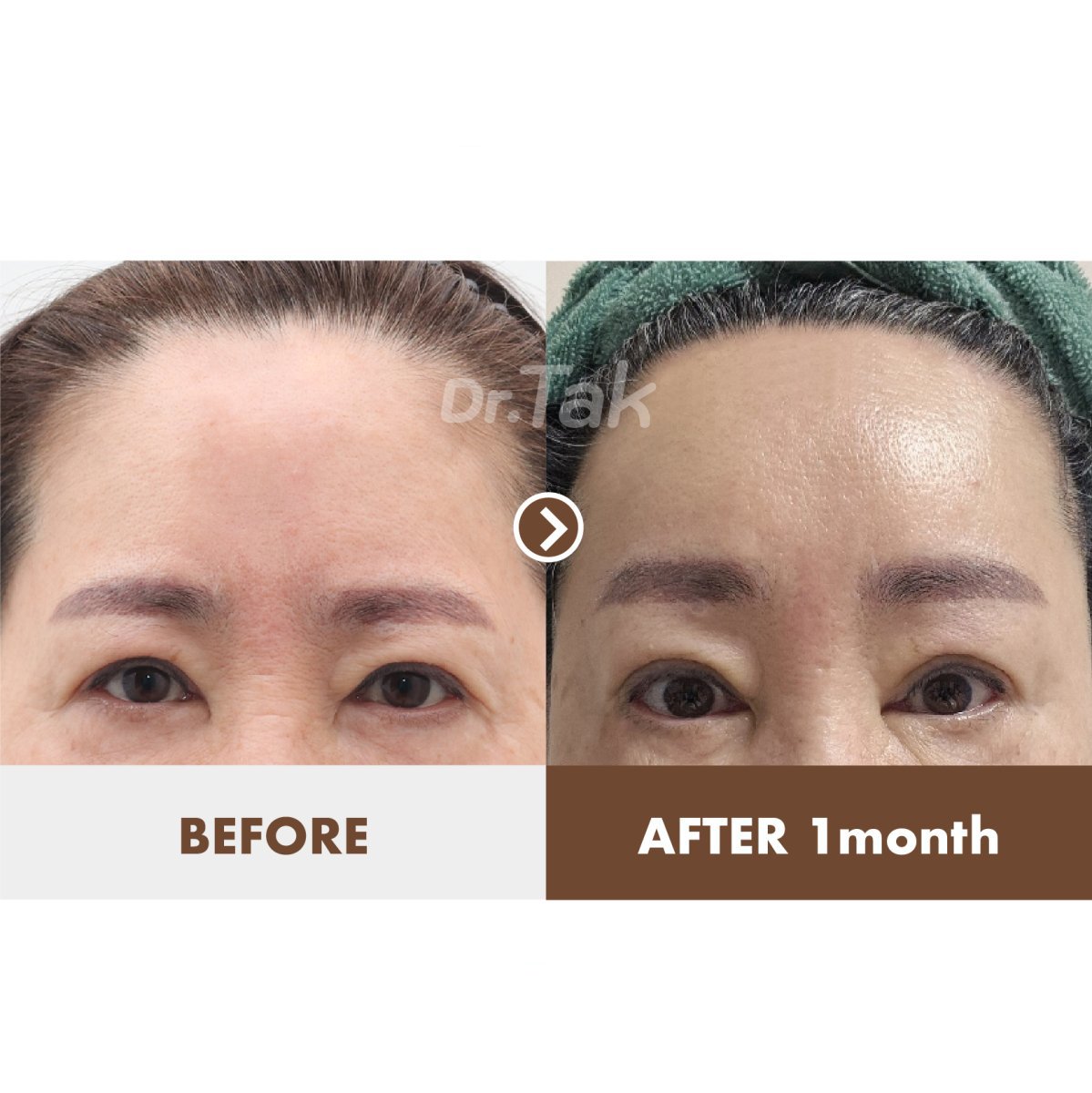 نتائج شد الجبهة قبل وبعد في Dr. Tak Plastic Surgery، جبهة أكثر نعومة بعد شهر