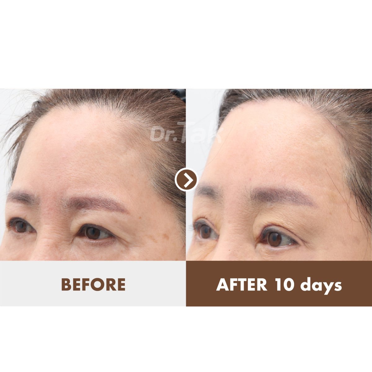 Efekty liftingu czoła przed i po w Dr. Tak Plastic Surgery, widoczne uniesienie brwi
