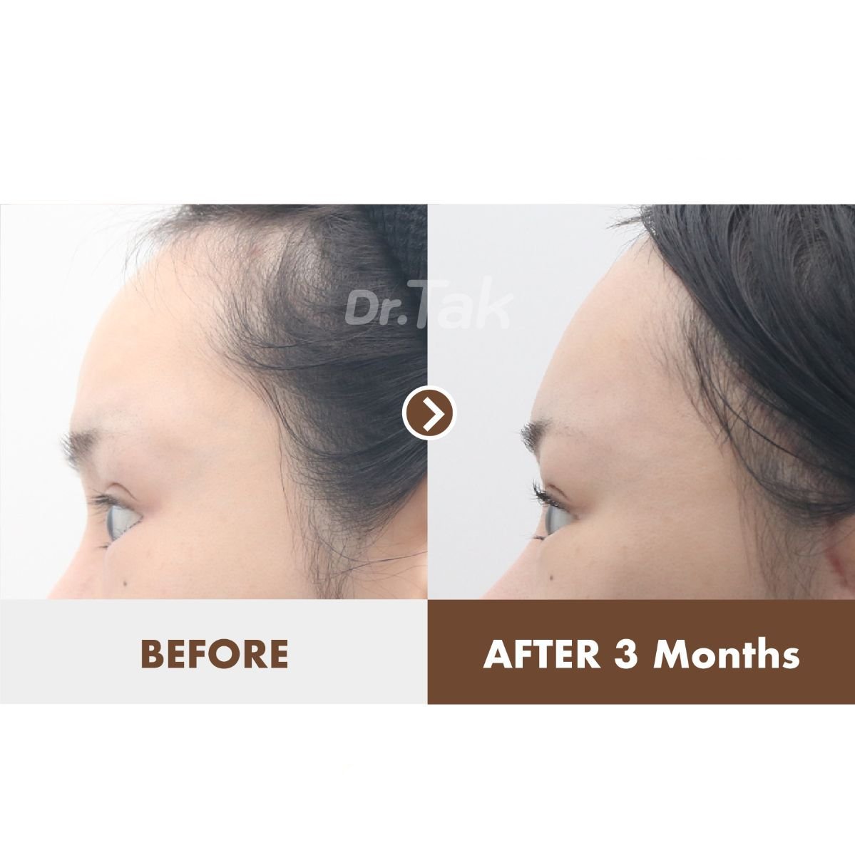 Efekty liftingu czoła przed i po w Dr. Tak Plastic Surgery, poprawiona linia włosów po 3 miesiącach