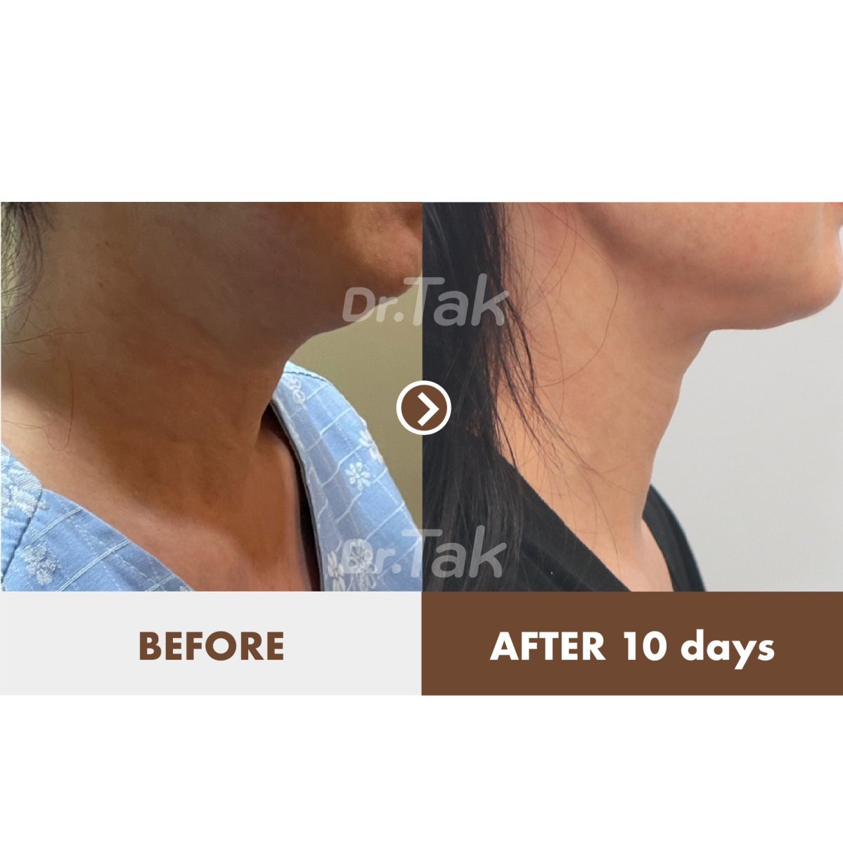 Before and after neck lift results at Dr. Tak Plastic Surgery, visible contour improvement
