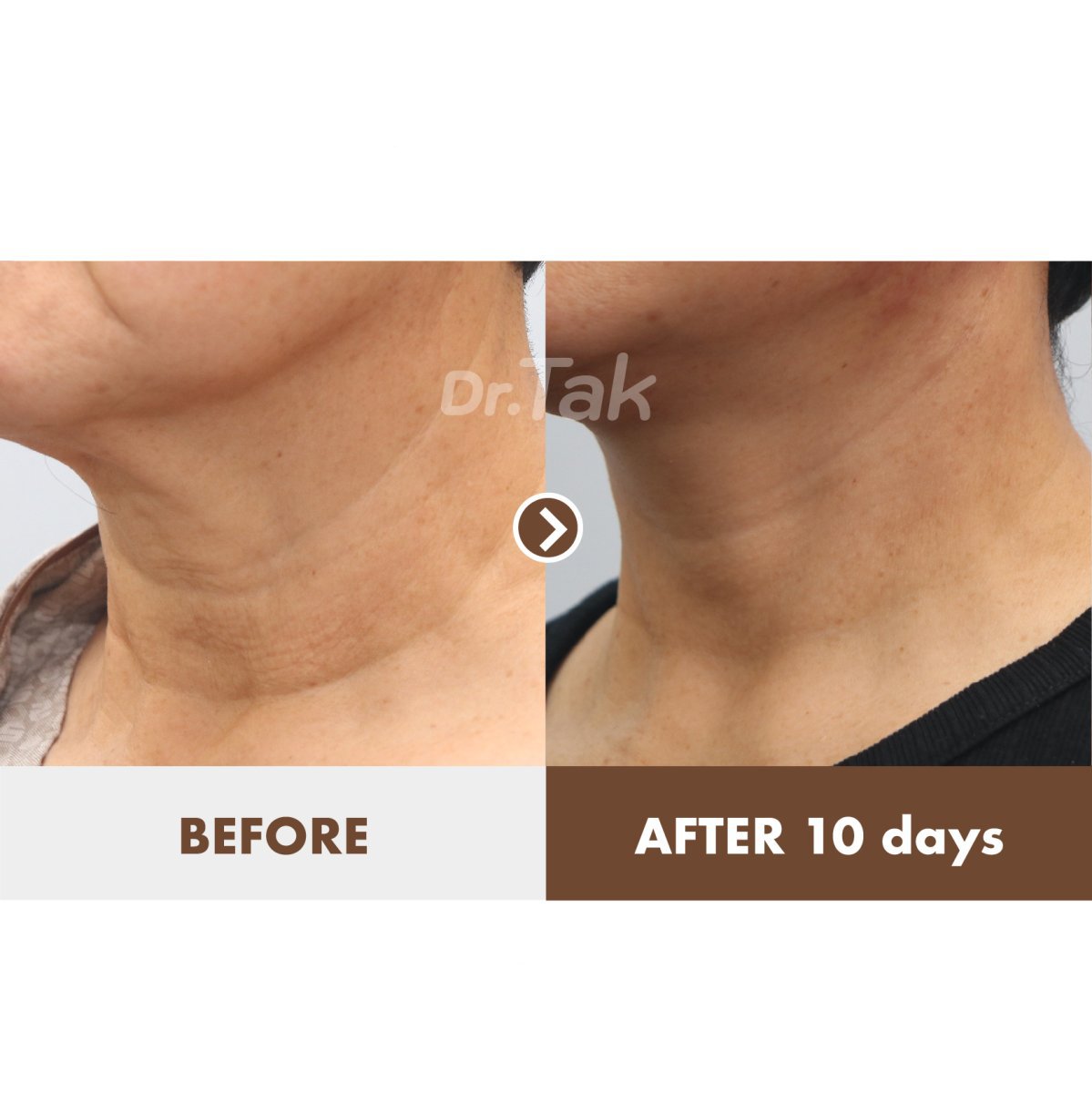 Before and after neck lift results at Dr. Tak Plastic Surgery, visible neck skin tightening