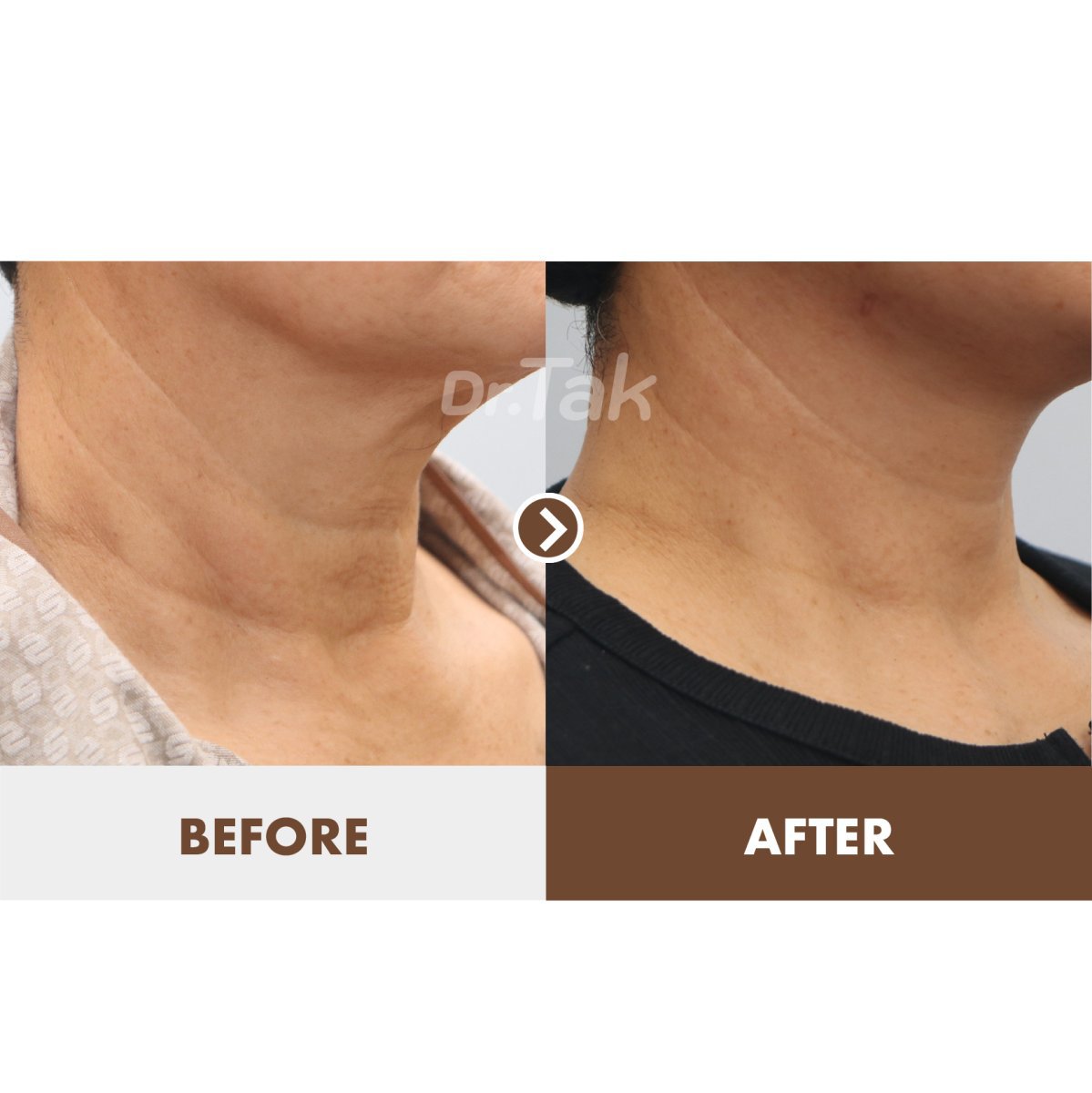Resultados de lifting de cuello antes y después en Dr. Tak Plastic Surgery, cuello más firme
