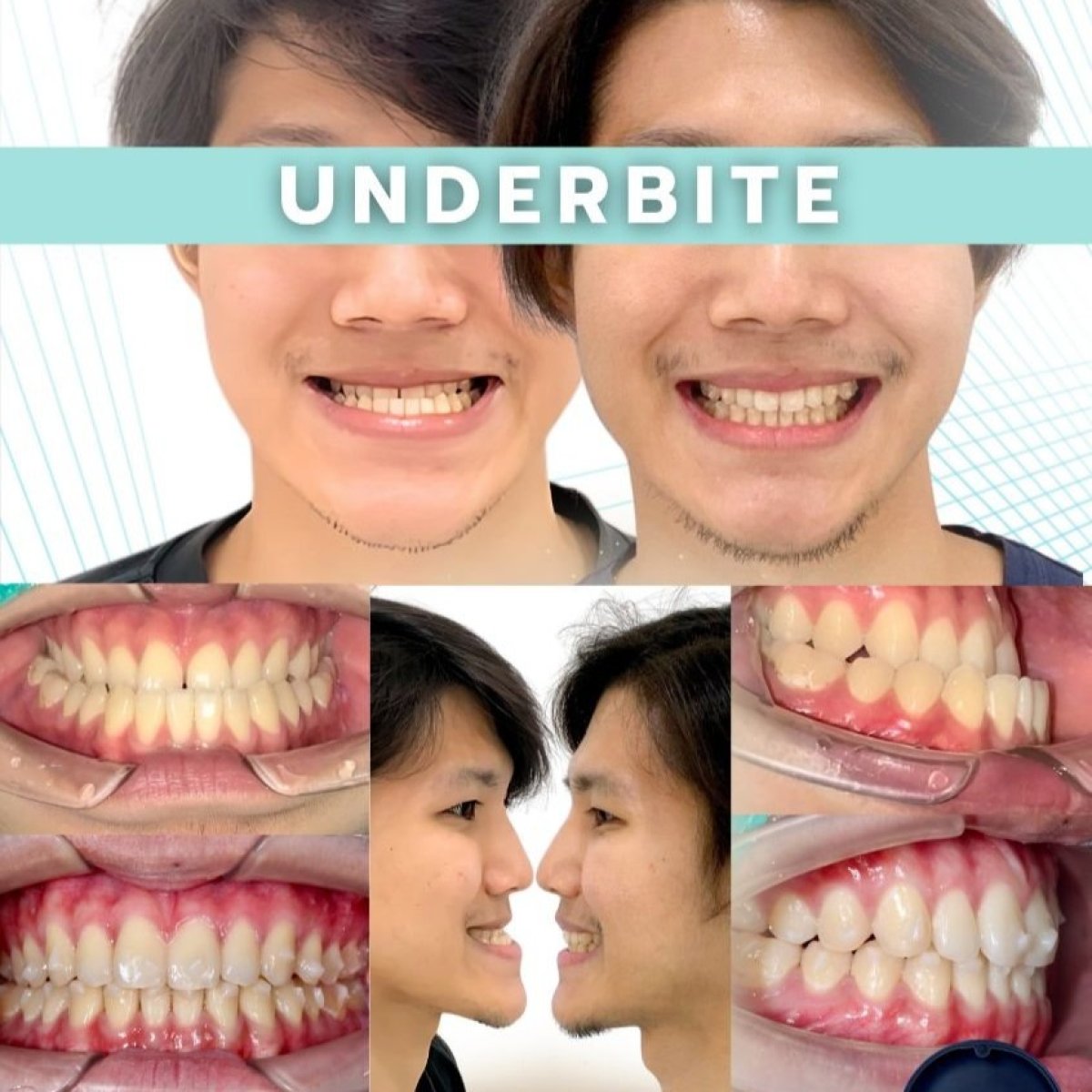 Corrección de prognatismo antes y después con alineadores en SmileBox Dental Clinic Thonglor resultado
