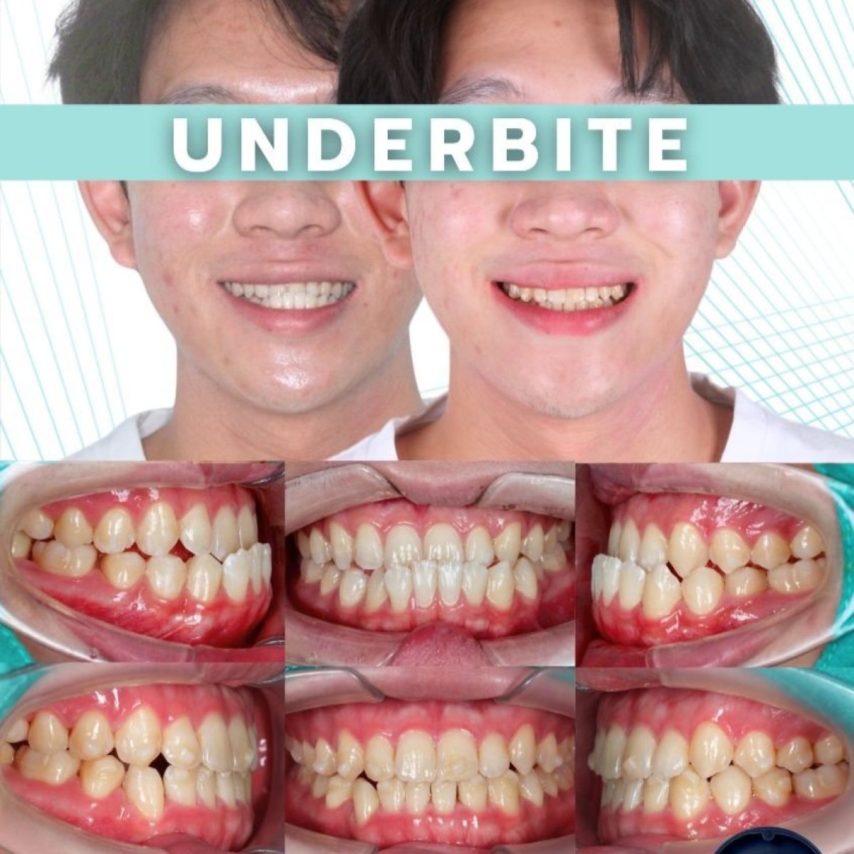 Corrección de mordida cruzada con alineadores antes y después en SmileBox Dental Clinic - Thonglor