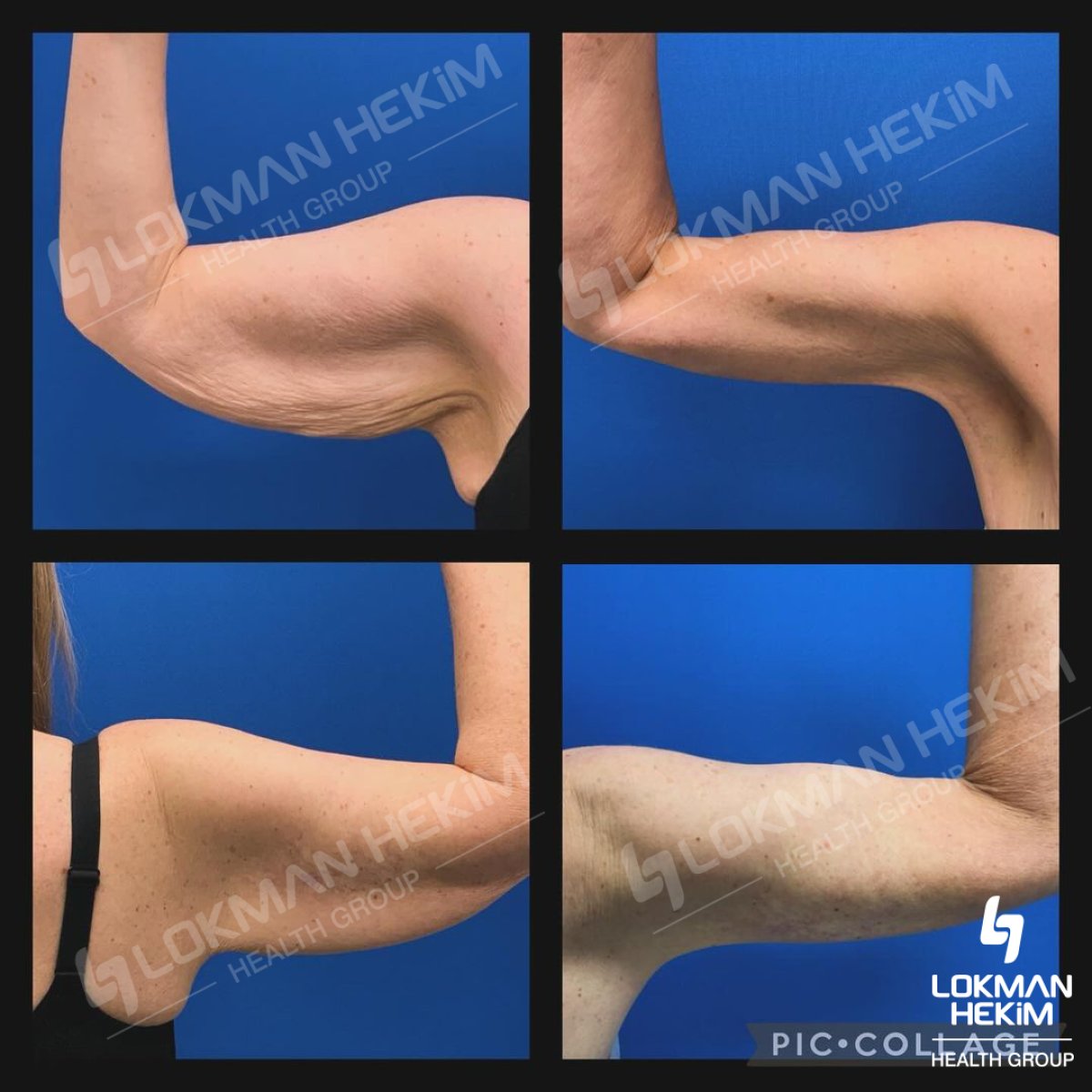 Результаты до и после брахиопластики в Lokman Hekim Istanbul Hospital, подтянутые руки