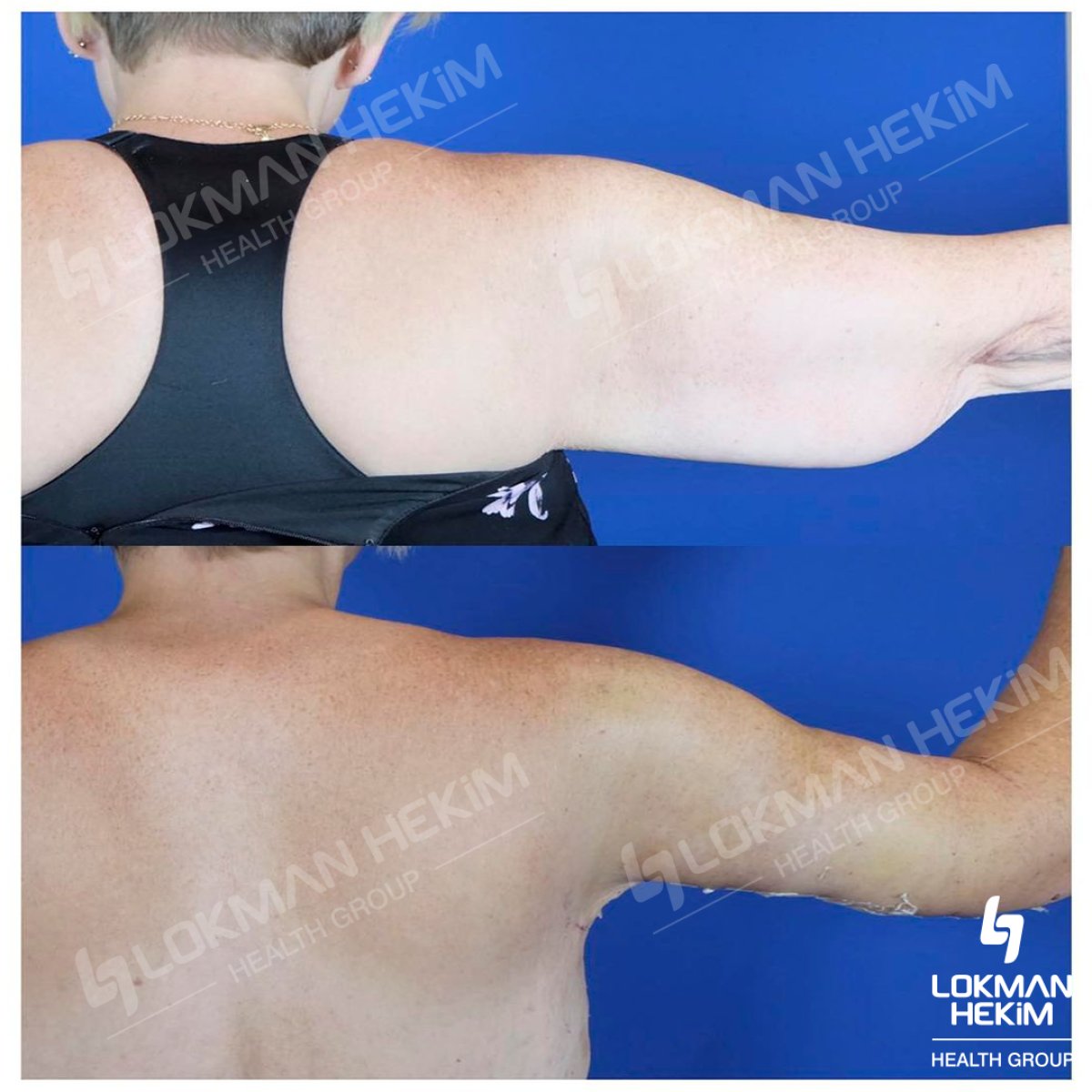 Before and after arm lift results at Lokman Hekim Istanbul Hospital, improved arm contour