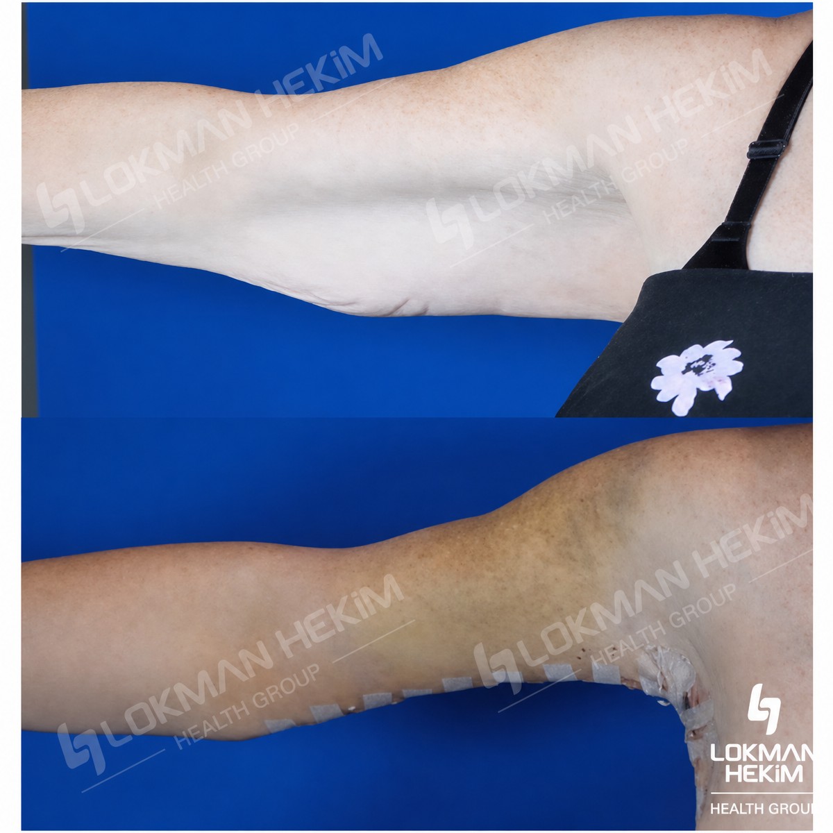 Before and after arm lift results at Lokman Hekim Istanbul Hospital, improved arm contour