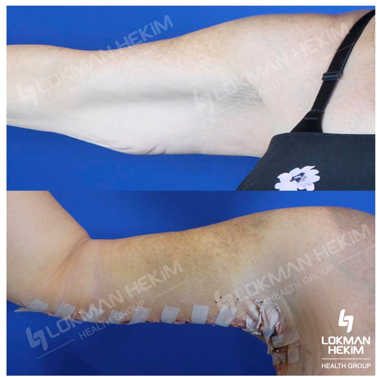 Resultados antes y después de lifting de brazos en Lokman Hekim Istanbul Hospital, braquioplastia