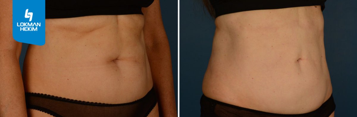 Before and after liposuction results at Lokman Hekim Istanbul Hospital, improved abdominal contour
