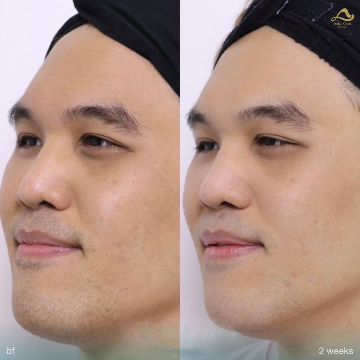 Resultados de botox preventivo antes y después en Anjali Clinic, frente más lisa tras 2 semanas