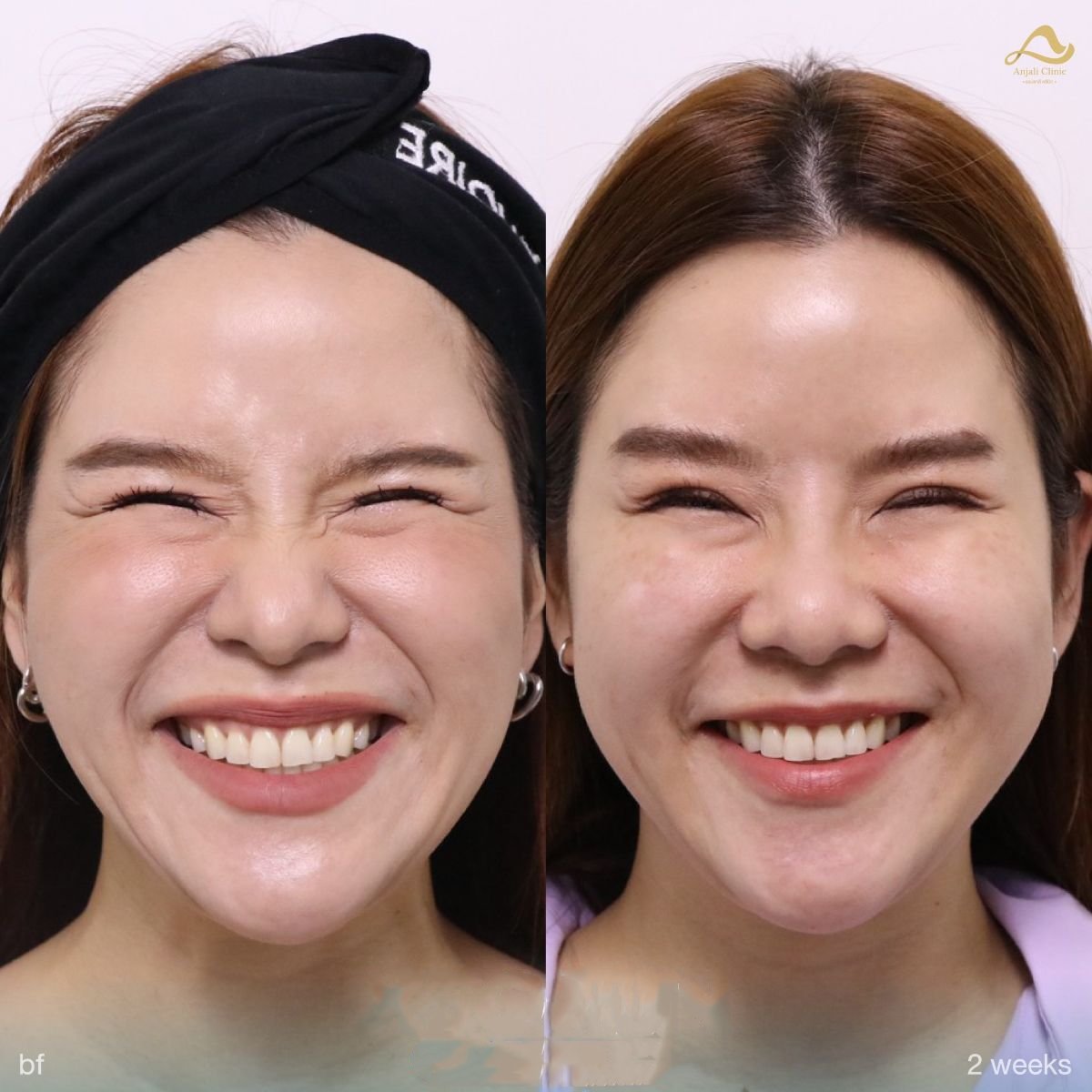 Before and after preventative botox results at Anjali Clinic, reduced smile lines in 2 weeks