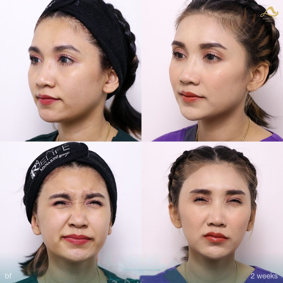 Preventative botox before and after results at Anjali Clinic, smoother forehead after 2 weeks