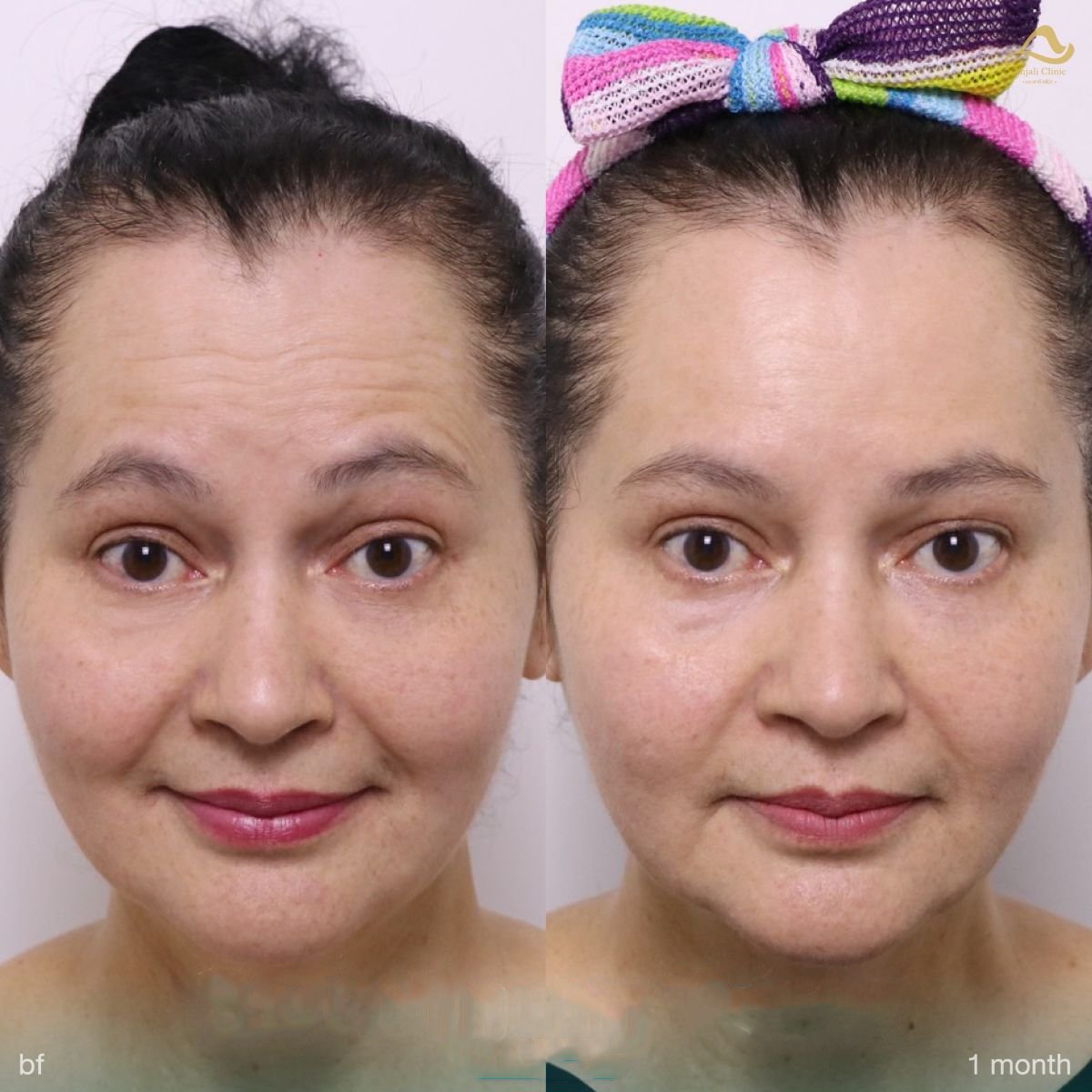 Before and after preventative botox results at Anjali Clinic, smoother forehead lines visible