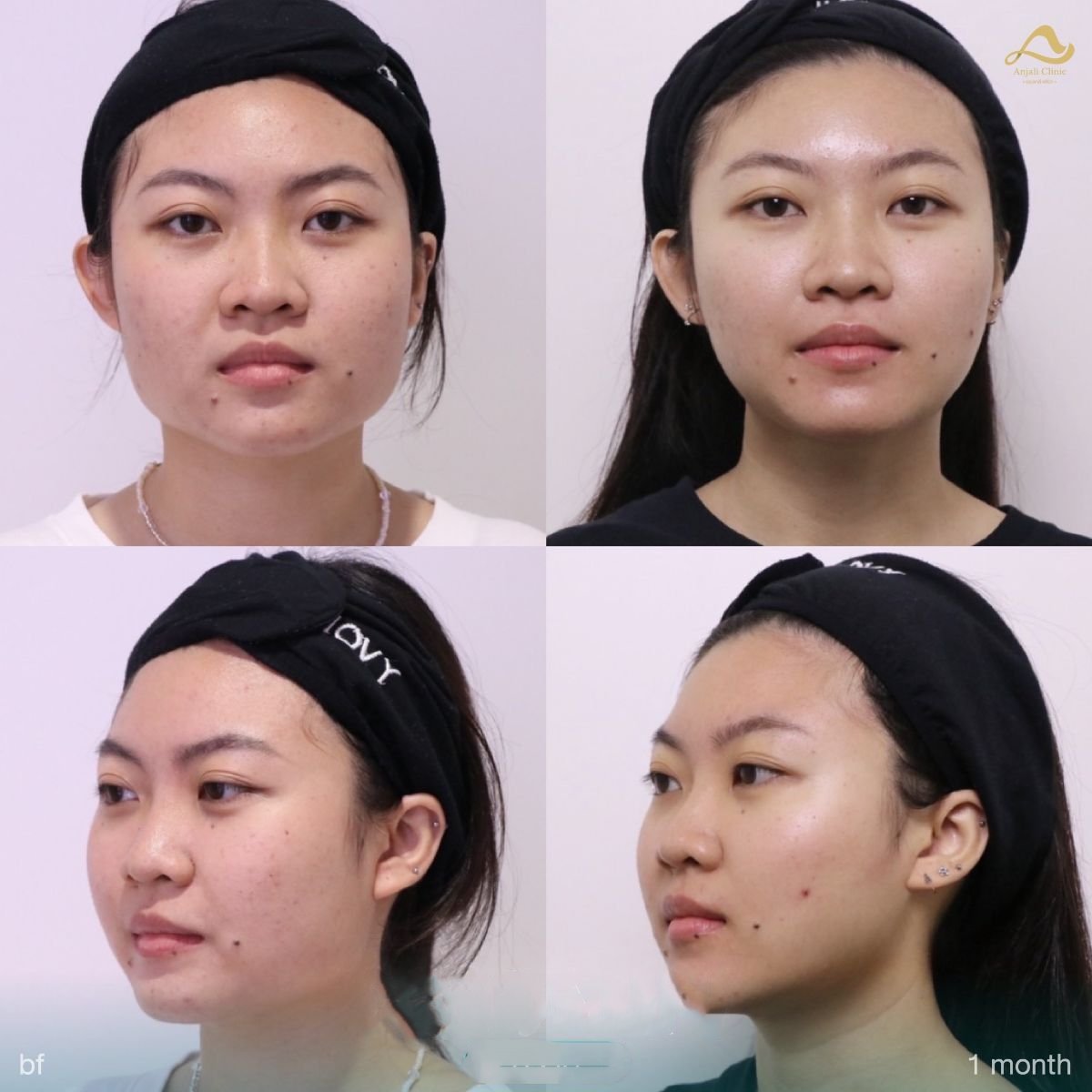Vorher-nachher-Ergebnis von präventivem Botox in der Anjali Clinic, glattere Haut nach 1 Monat