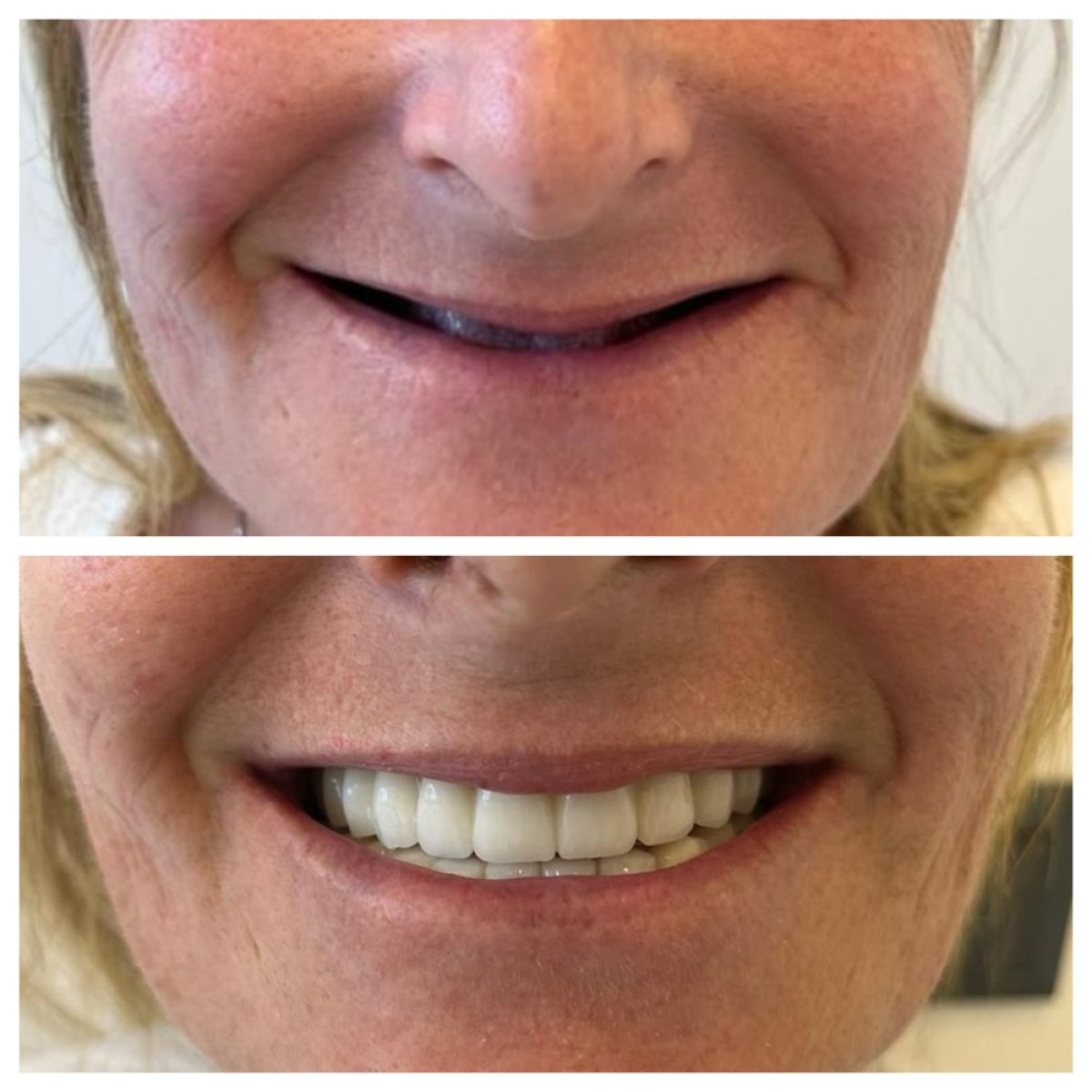 Before and after All-on-6 dental implants result at My Nova Kusadasi Dental Clinic, smile restored