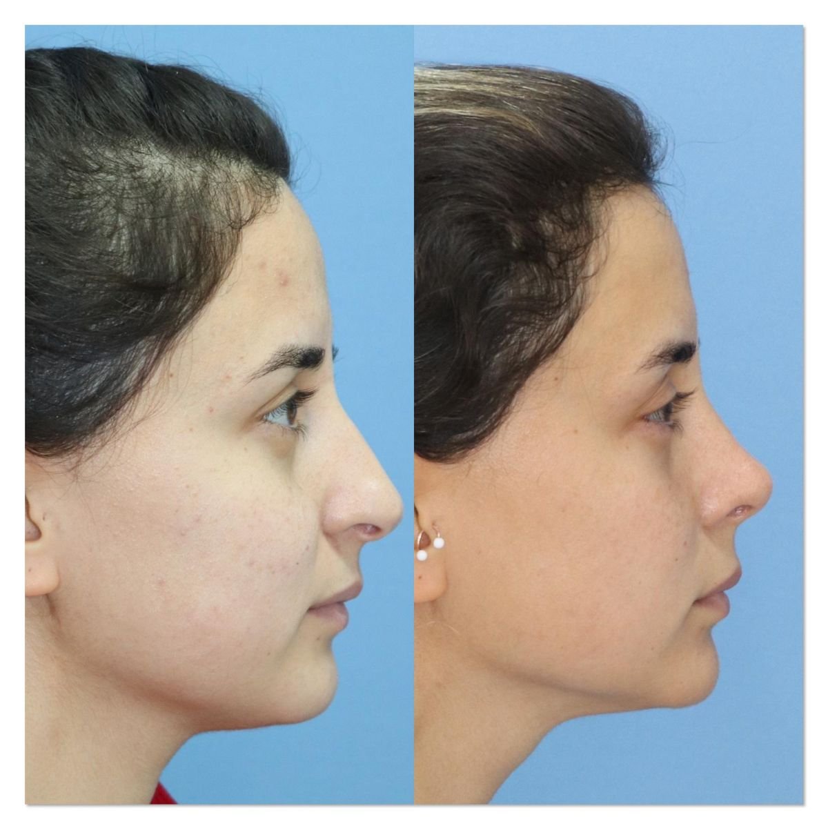 Resultados de rinoplastia antes y después en Dr. Safa Manav Clinic, mejora de la nariz