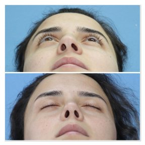 Premium Rhinoplasty (nose job) with European Board Certified Doctor Ali Sadioglu - photo 2