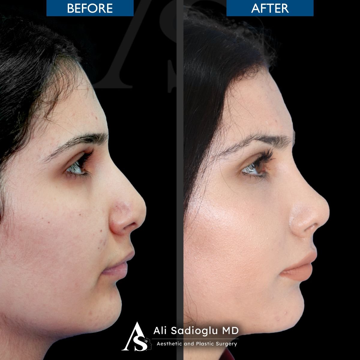 نتائج تجميل الأنف قبل وبعد في عيادة Dr. Safa Manav، إعادة تشكيل الأنف بمظهر طبيعي