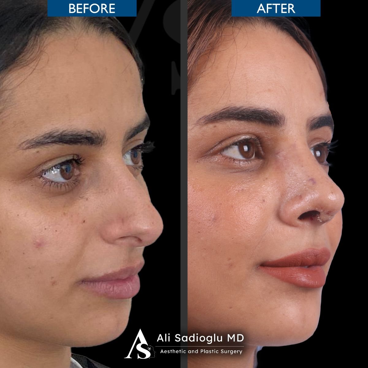 نتائج عملية تجميل الأنف قبل وبعد في عيادة Dr. Safa Manav، تحسين شكل الأنف
