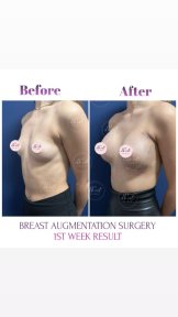 Premium Rhinoplasty with Double Board Certified Surgeon