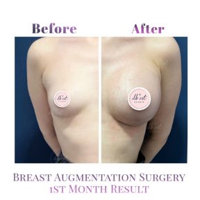 Premium Rhinoplasty with Double Board Certified Surgeon - photo 3