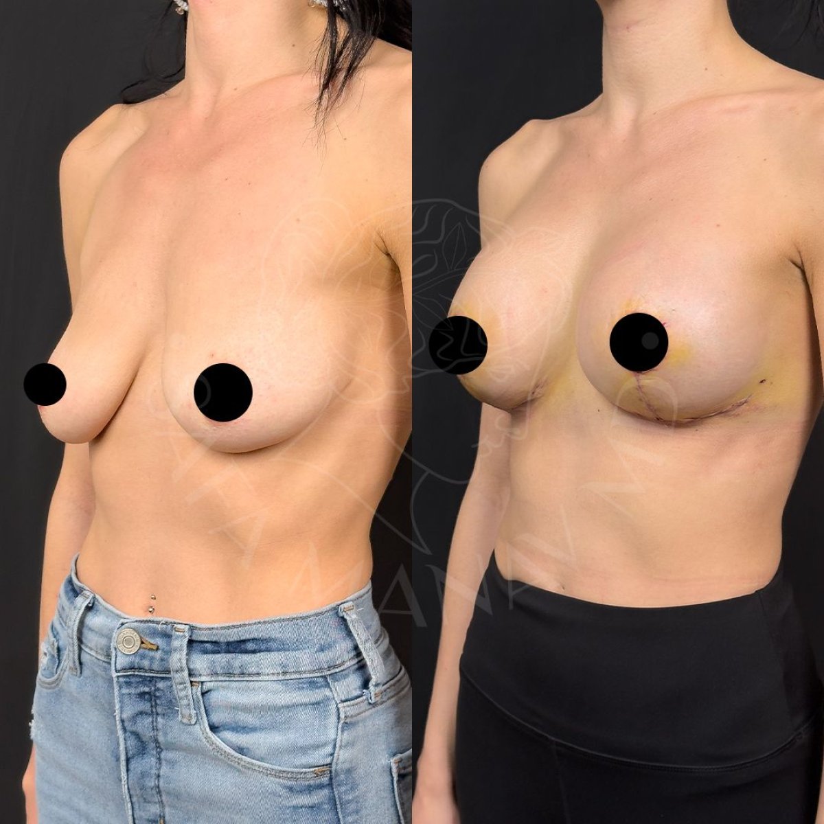 Before and after breast augmentation results at Dr. Safa Manav Clinic, enhanced breast shape