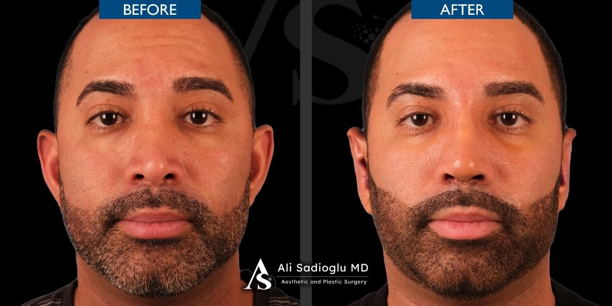 Resultados de rinoplastia antes y después en Dr. Safa Manav Clinic, forma de nariz mejorada