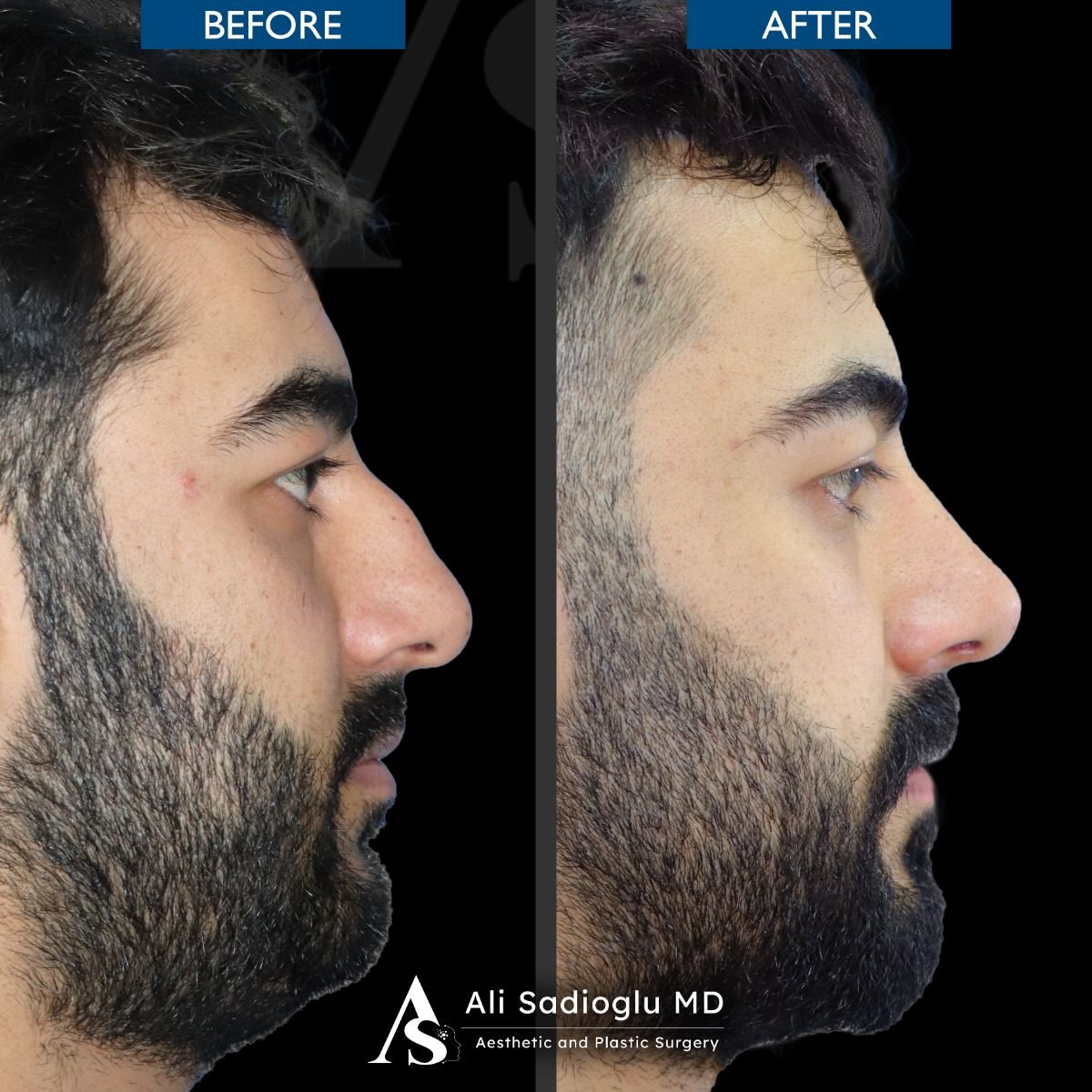 نتائج عملية تجميل الأنف قبل وبعد في عيادة Dr. Safa Manav، تحسين شكل الأنف